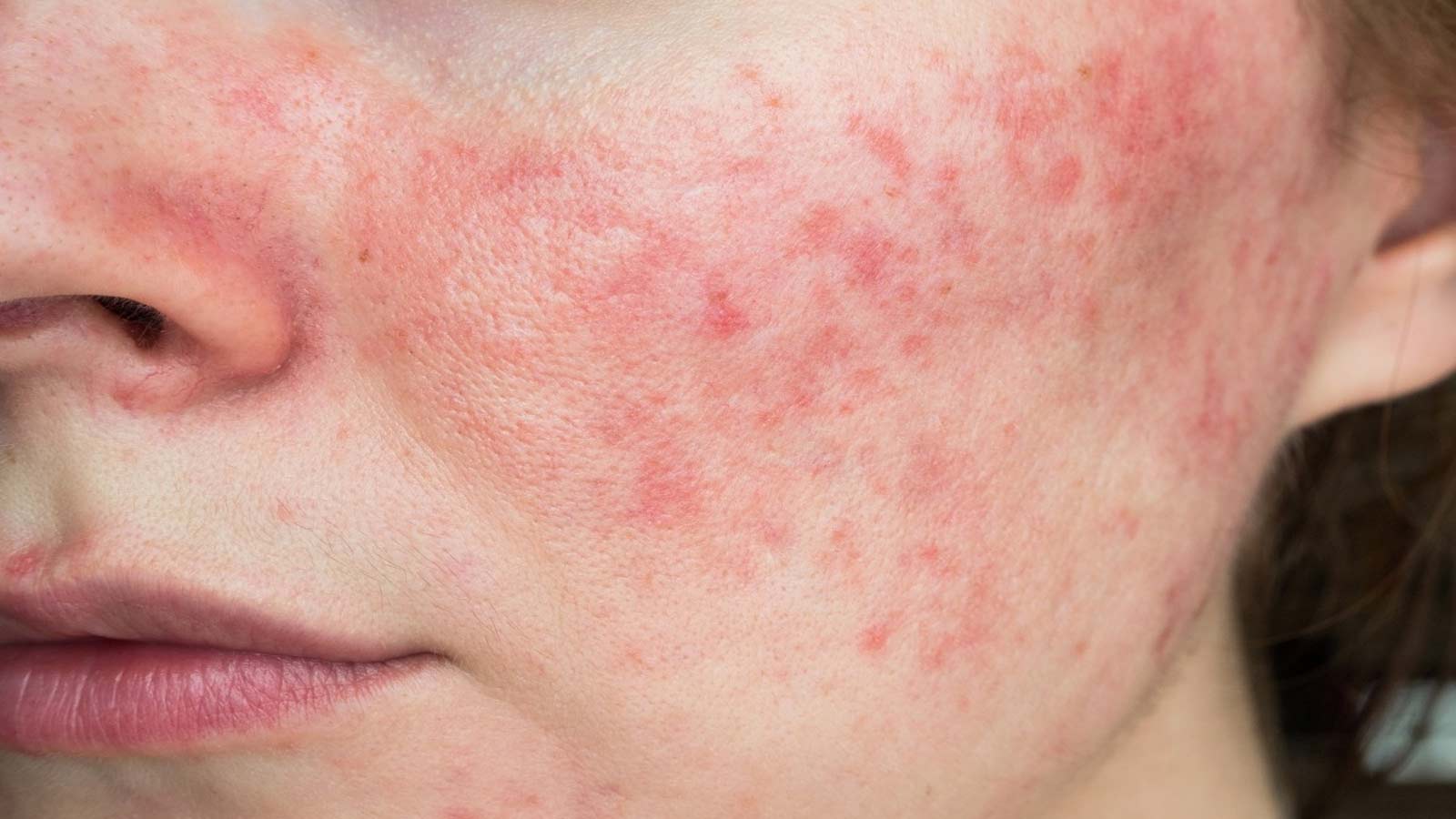 Da đỏ rát, bong tróc và châm chích là dấu hiệu cần nghĩ đến kích ứng khi treatment