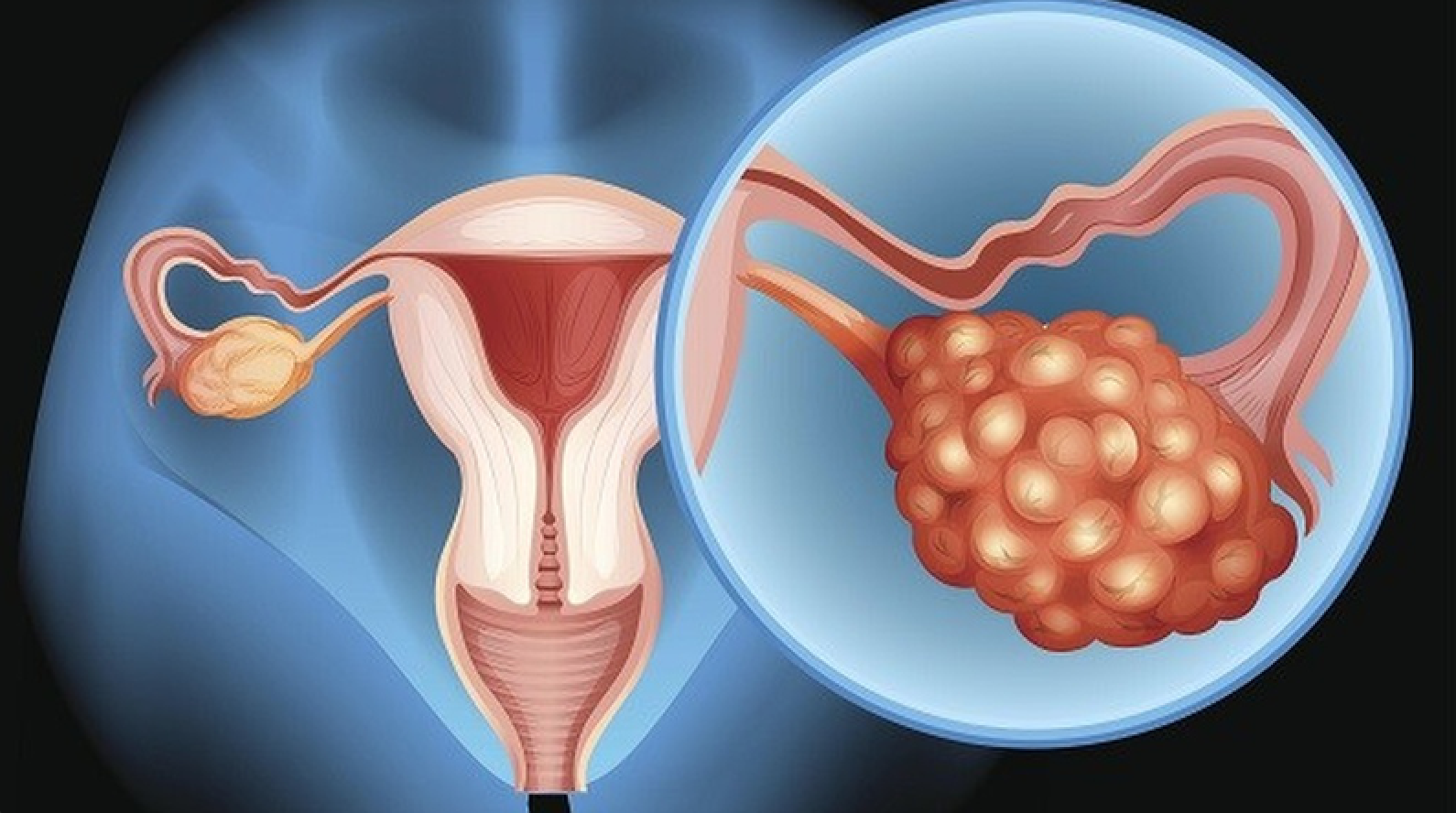 Lạc nội mạc buồng trứng có thể làm giảm khả năng mang thai lần hai