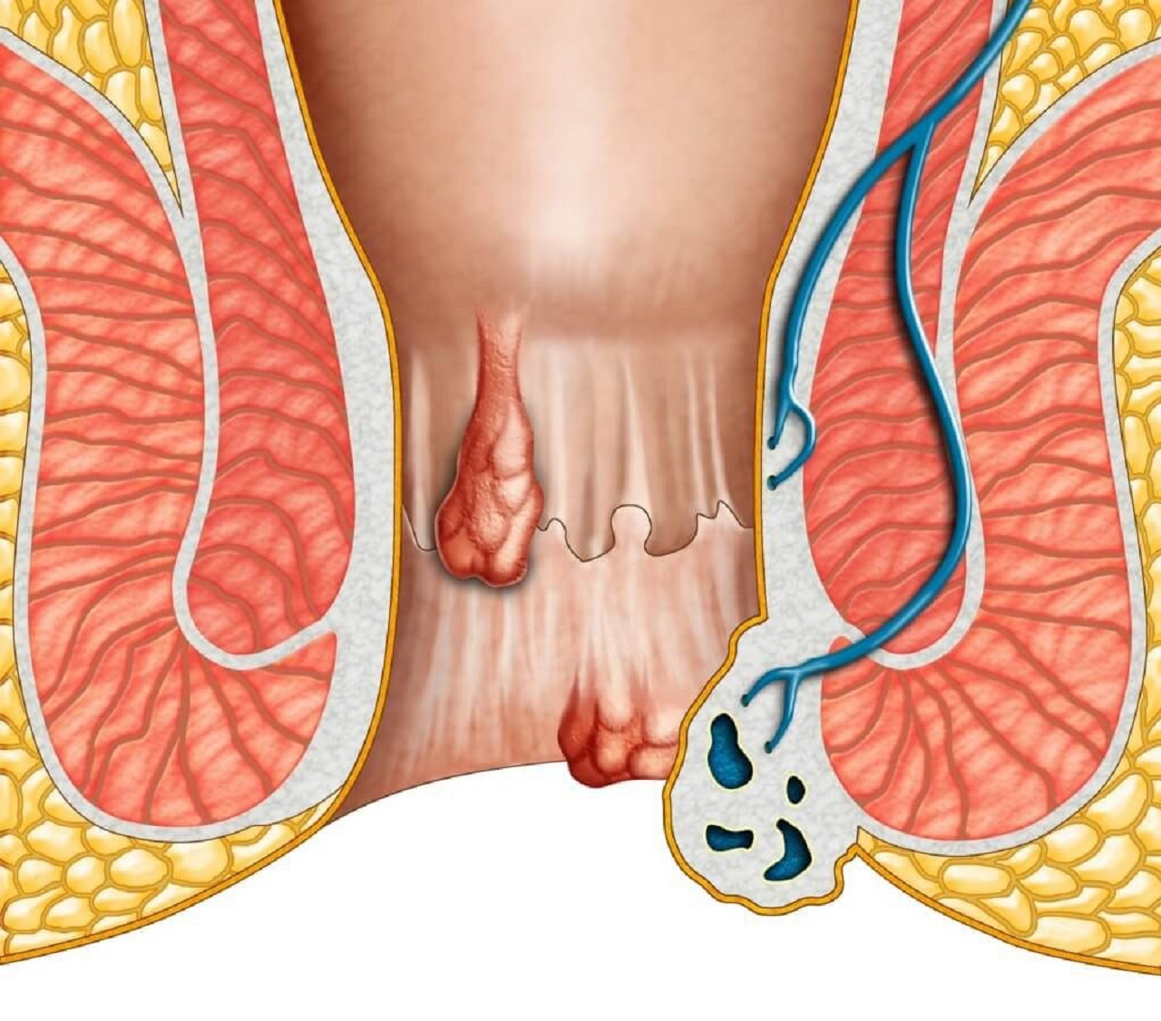 Ngồi xổm khi đi WC hỗ trợ phòng bệnh trĩ