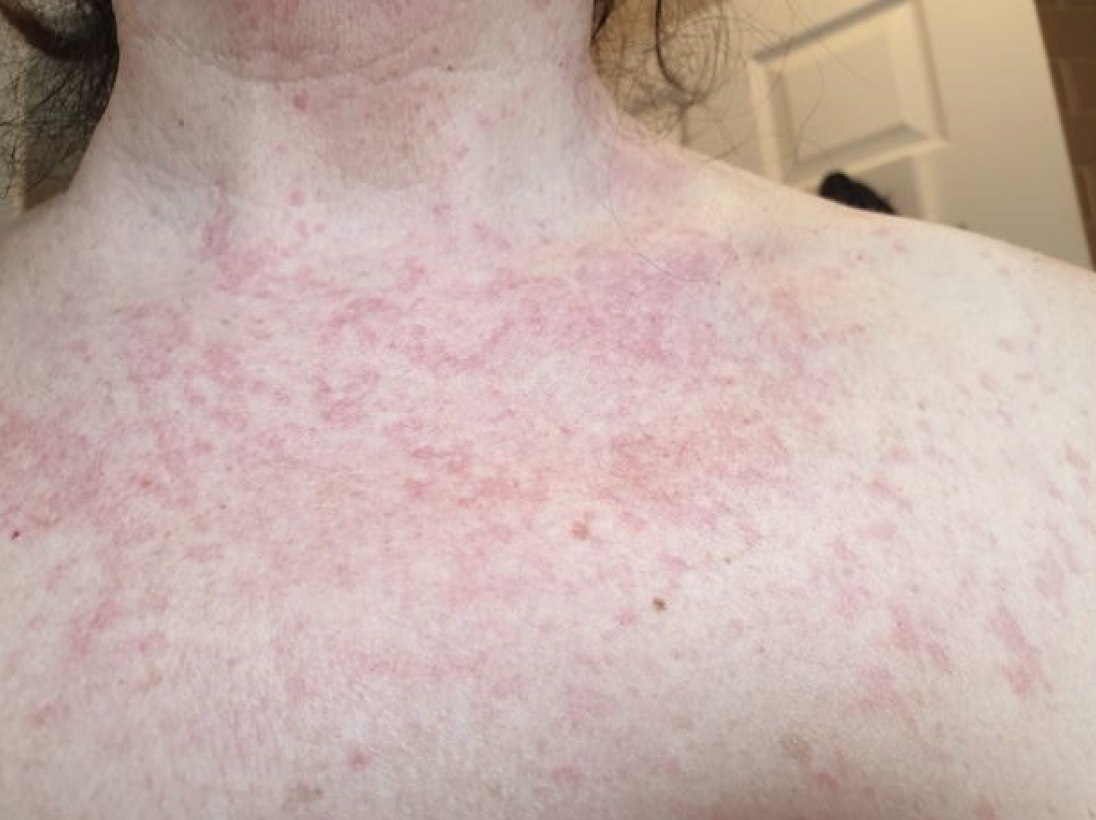 Phân biệt phát ban do virus và dị ứng ngoài da qua đặc điểm triệu chứng đi kèm