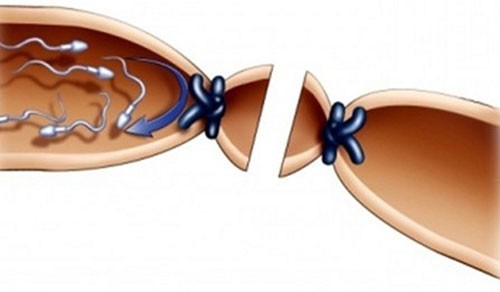 Tắc ống dẫn tinh khiến tinh trùng không thể xuất ra ngoài dù vẫn được sản xuất