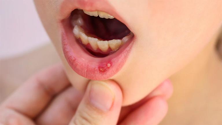 Loét miệng khiến trẻ đau đớn và ngại ăn uống
