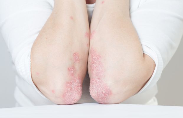 Bệnh vảy nến có thể đến từ yếu tố di truyền hoặc môi trường